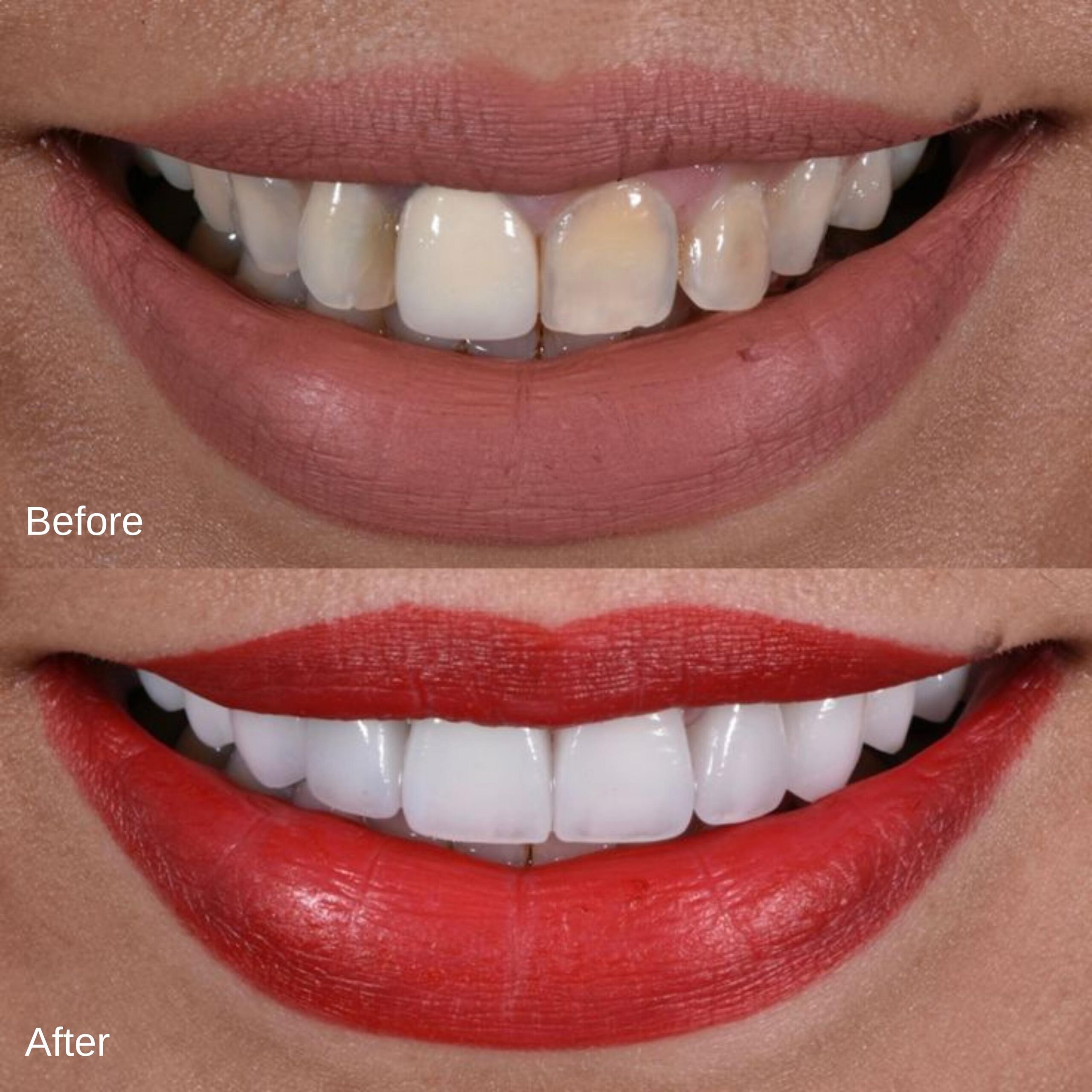 Before And After Veneers #17