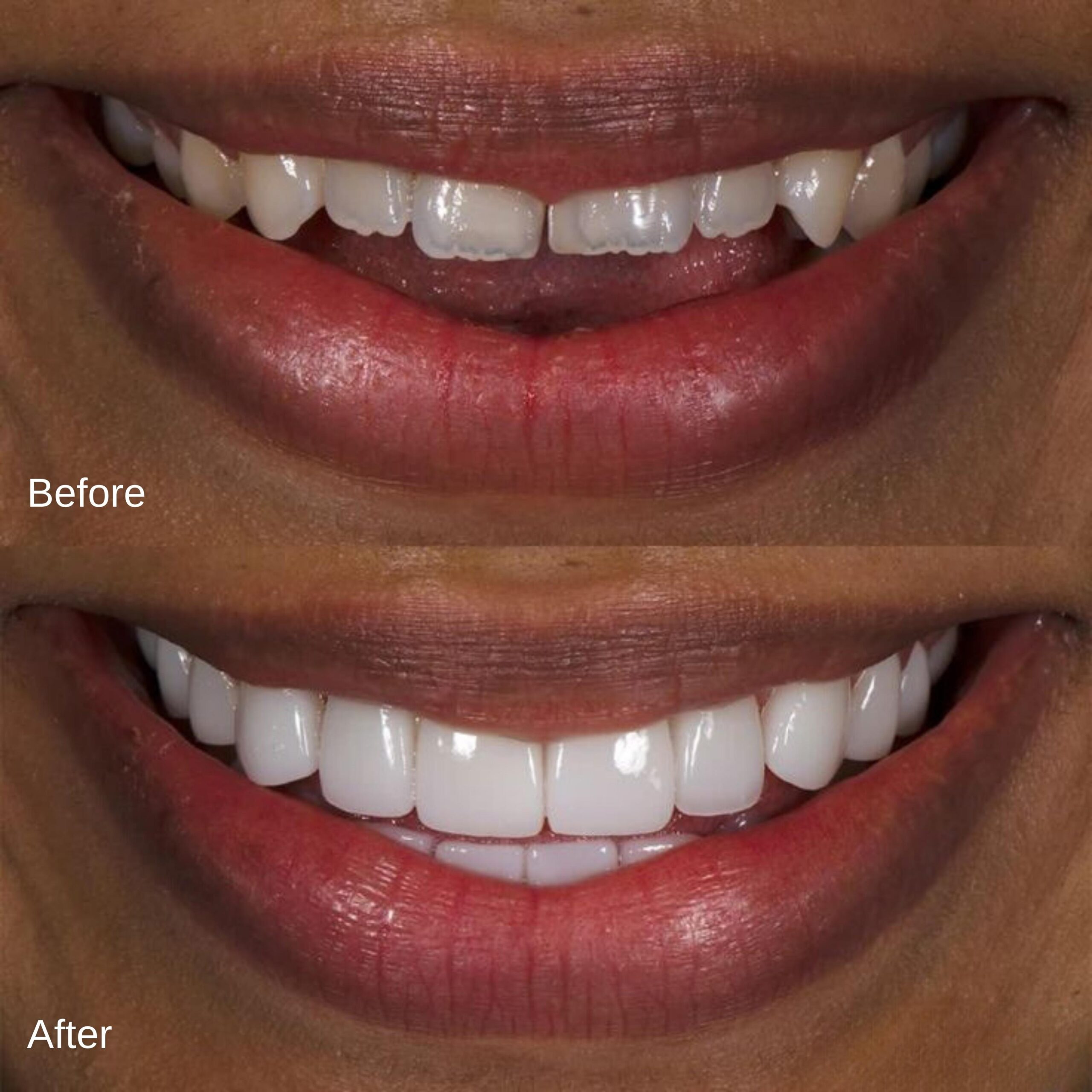 Before And After Veneers #8