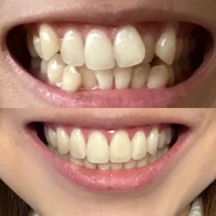 Before after invisalign 1